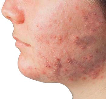 Cara de un joven con hidradenitis