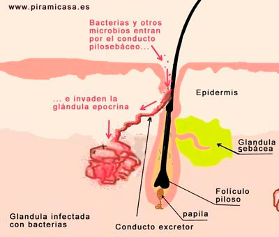 Glándula sudorípara infectada por bacterias