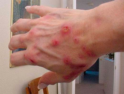 Mano afectada con morgellons